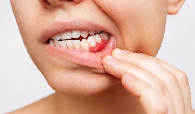 Yaygın Diş ve Diş Eti Hastalıkları Nedir?