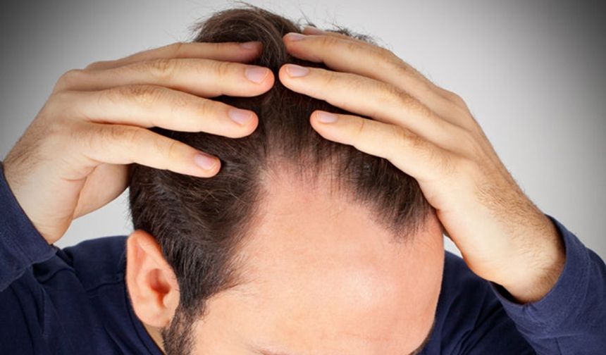 Erkeklerde Saç Dökülmesi Nasıl Önlenir ve Tedavi Edilir?